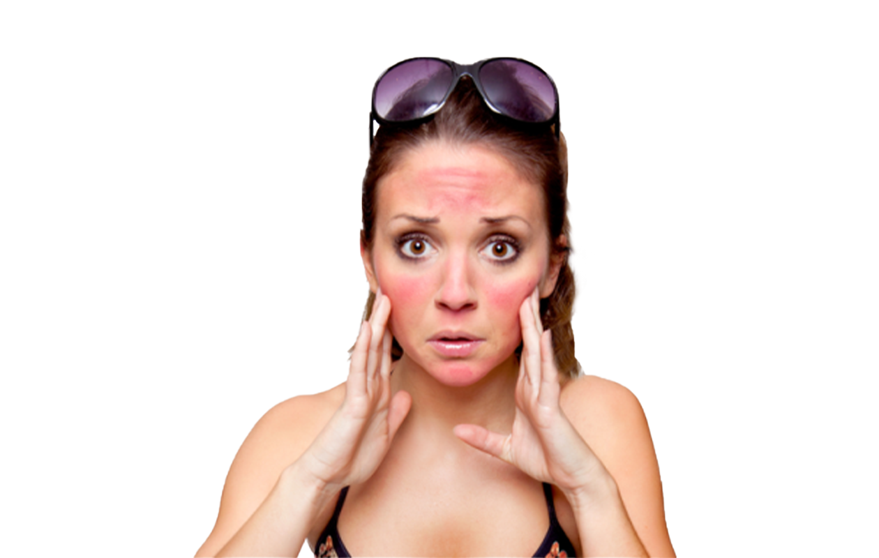 Image of woman with sunburned face with sunglasses lifted up on her head.