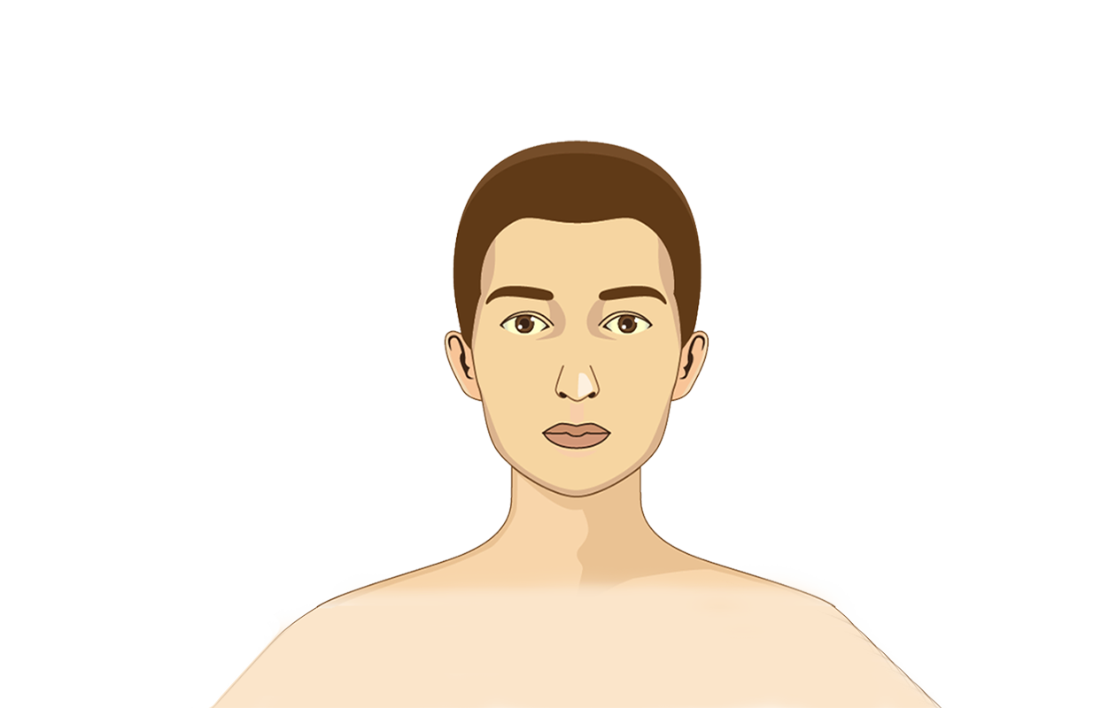 Image of person with yellowing skin caused by jaundice
