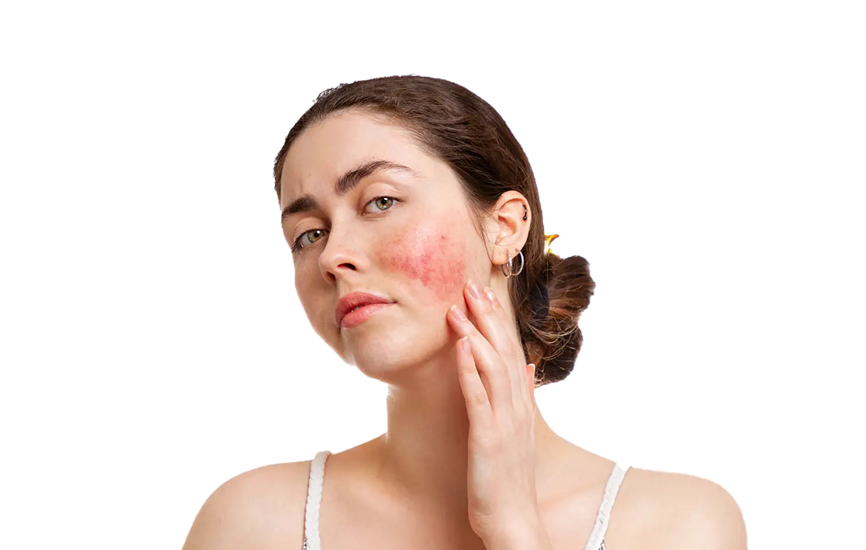 Image of woman displaying rash on face, one of the symptoms of Lupus.