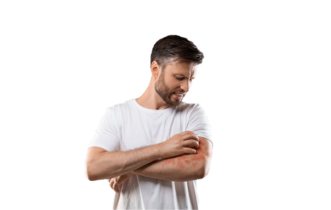 Photo of man scratching arm with rash from psoriasis