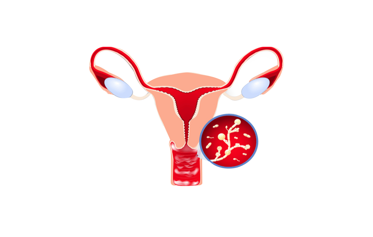 Image depicting woman's reproductive system with yeast infection