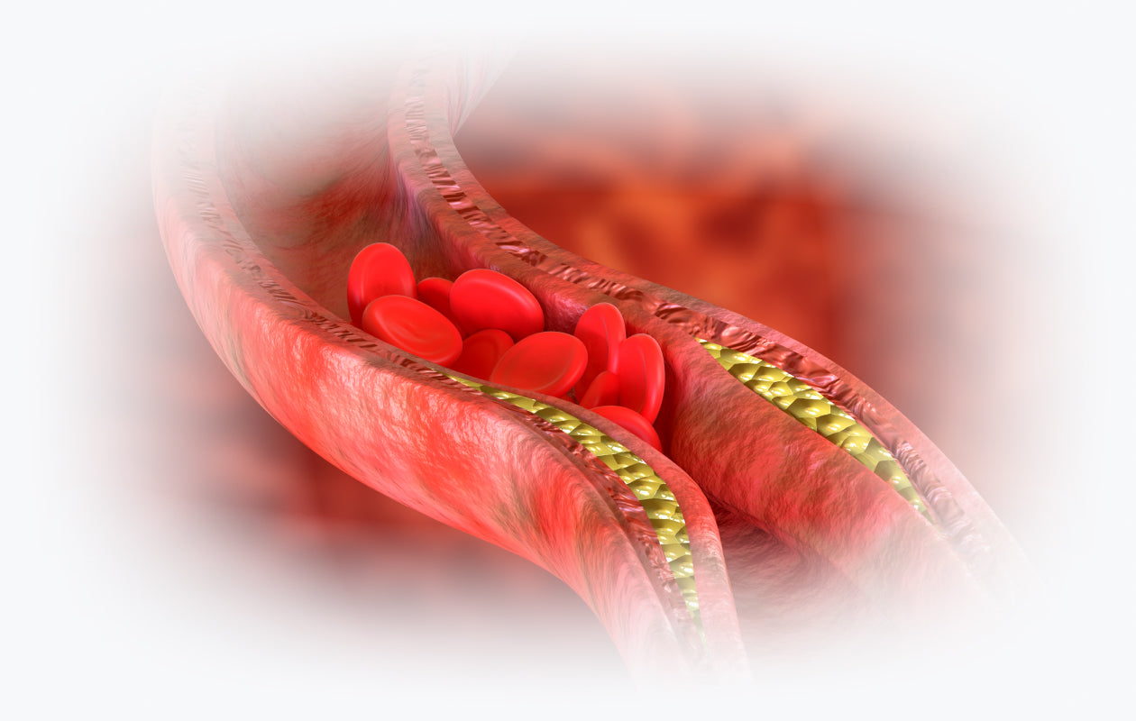 Image of blocked artery