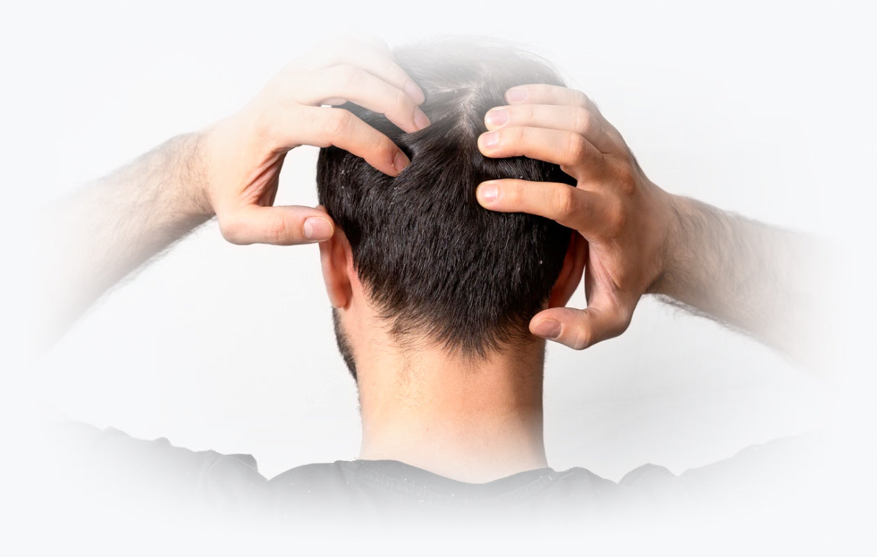 Photo of back of mans head and his hands scratching his scalp because of dandruff