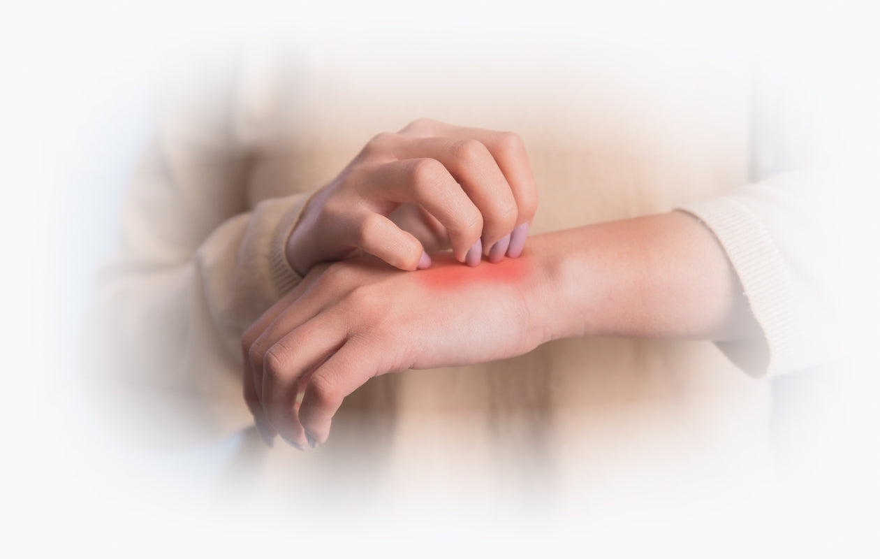 Woman scratching rash on hand caused by eczema