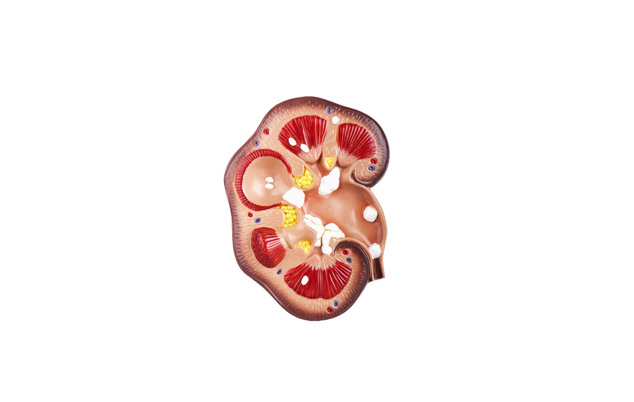 Cross-section drawing of kidney with kidney stones