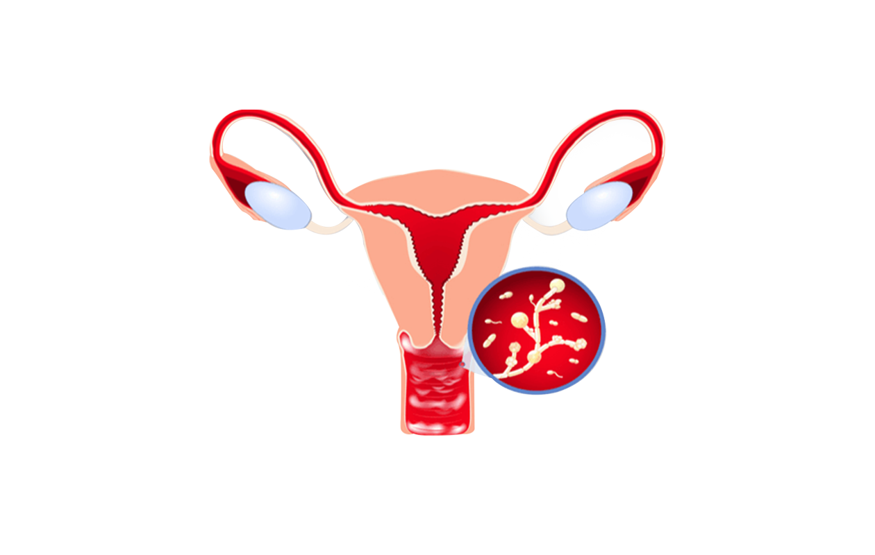 Image depicting woman's reproductive system with yeast infection 