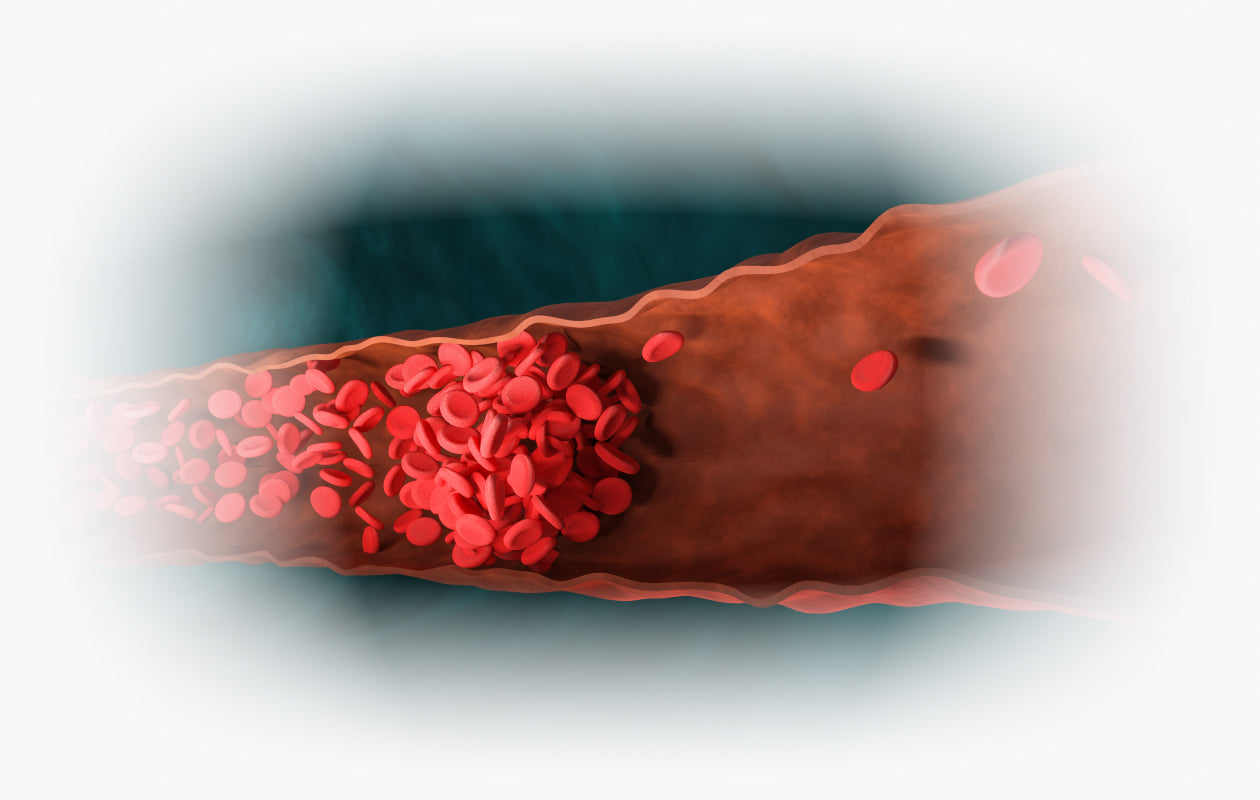 Image of an artery clogged by a blood clot