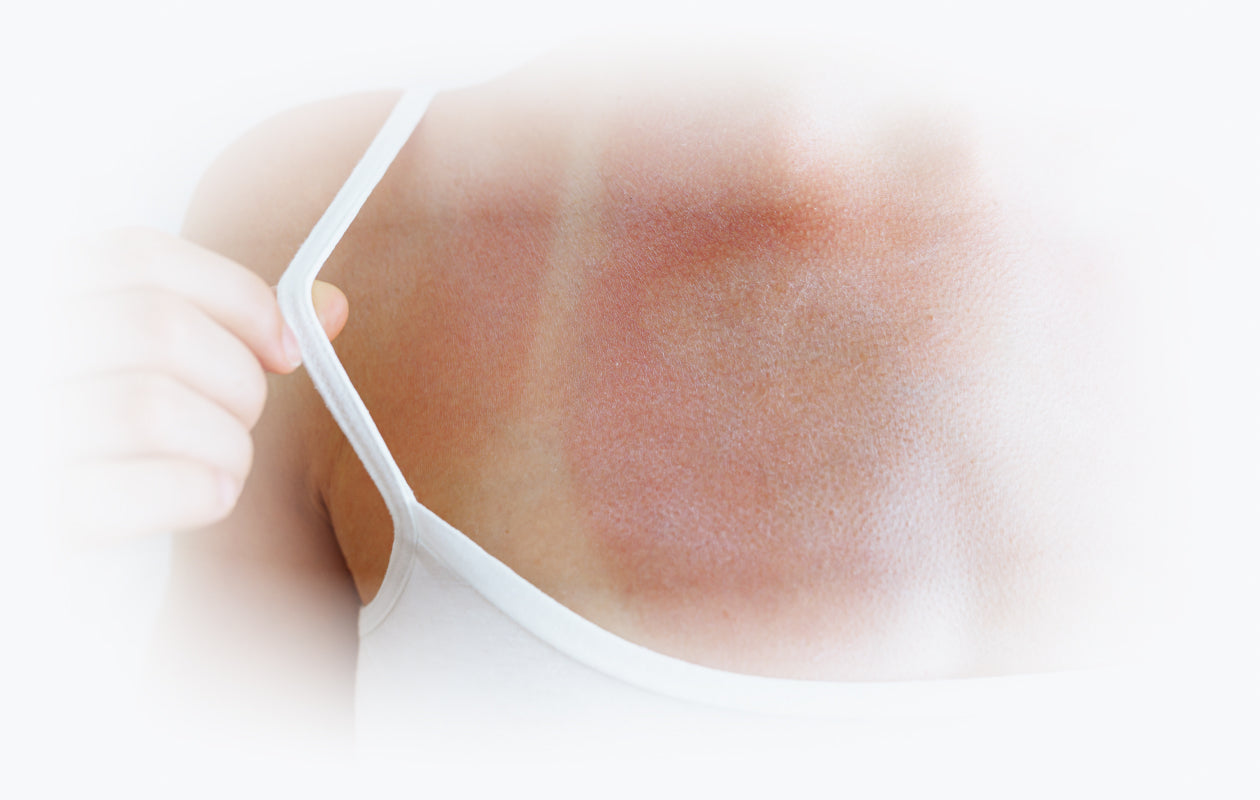 Image of a person's sunburned chest